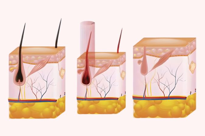 Folículo Depilación Láser con diodo